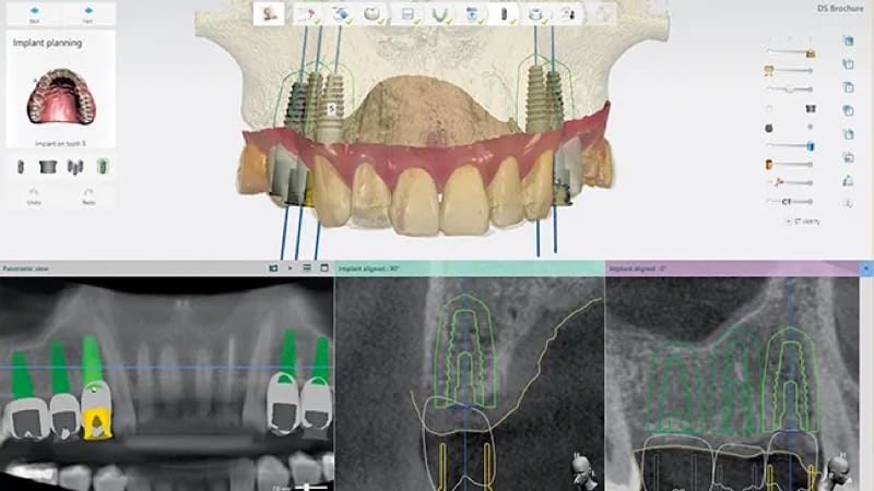 outils de CAO de dentisterie